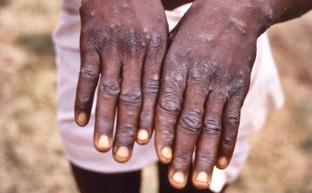 South Sudanese Refugee Tests Positive for Mpox in Adjumani